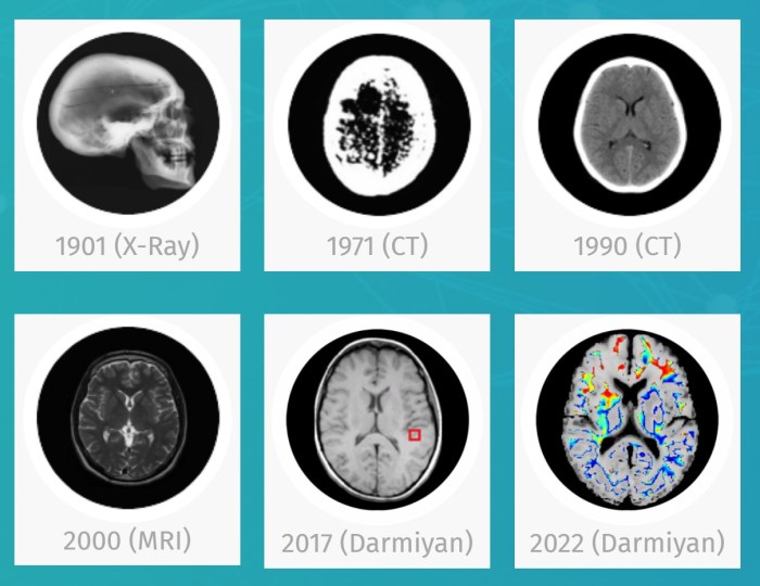 Ai can detect alzheimers early